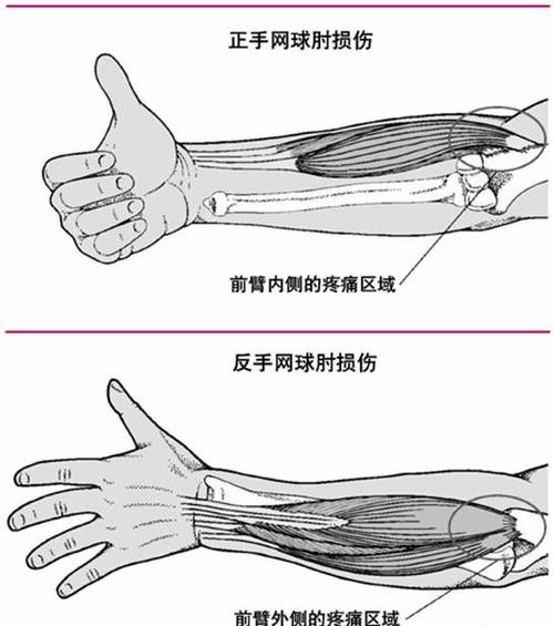 钓鱼如何不伤手肘，钓鱼怎么保护手腕！